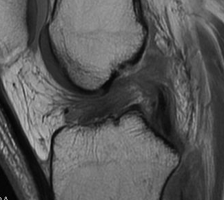 MRI ACL torn and healed on PCL